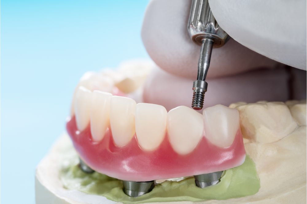 How Much Are Dental Implants cost