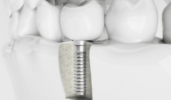 How Much Do Dental Implants Cost with Cigna Insurance? A Quick Guide