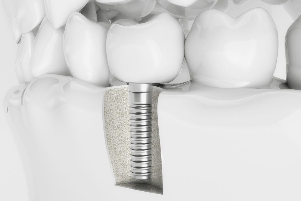 How Much Do Dental Implants Cost with Cigna Insurance