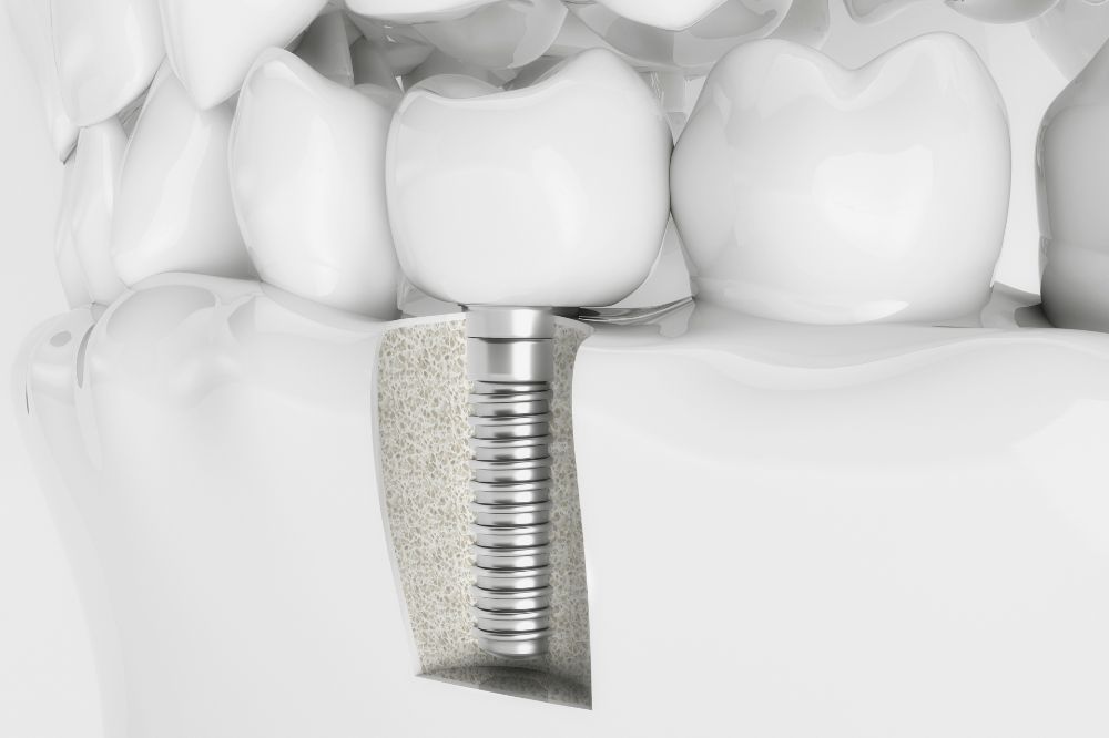 How Much does Dental Implants cost