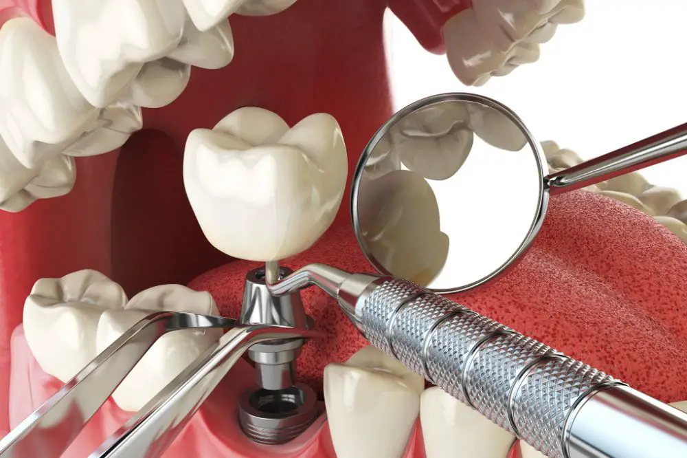 What are dental implants and how do they work?