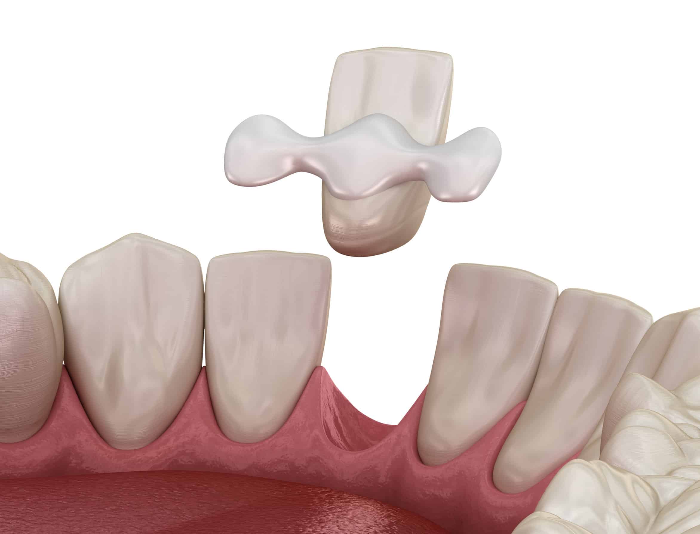 Bonded dental bridges