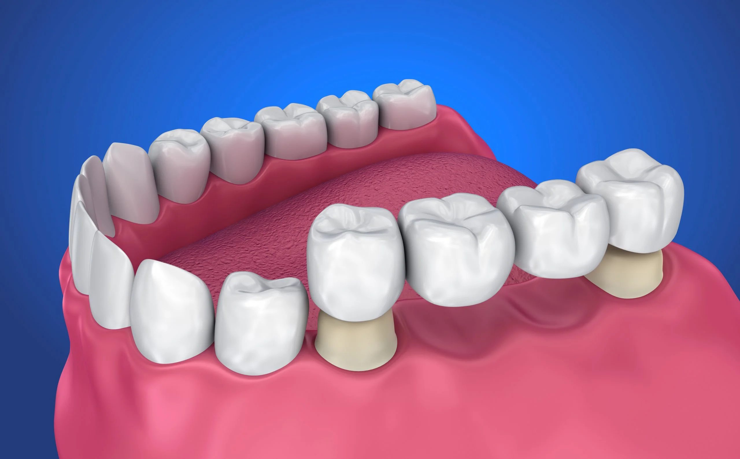 Different Types of Dental Bridges