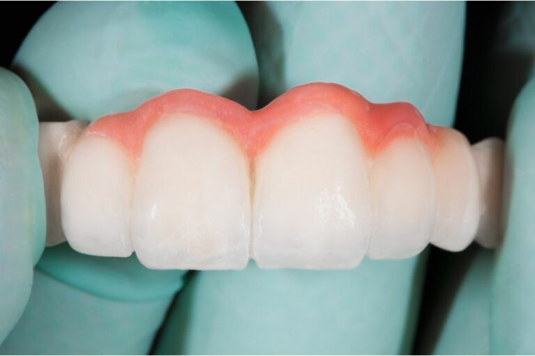 How Long Do Dental Bridges Last? (Details)