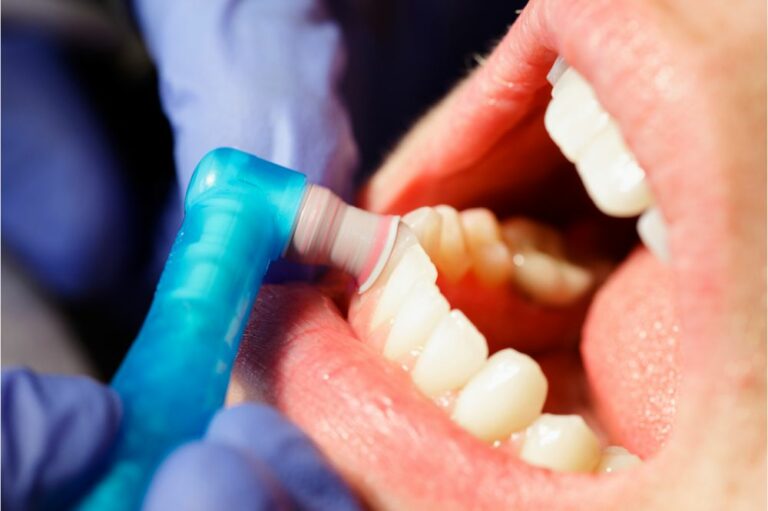 How Long Do Dental Cleanings Take? (Details)