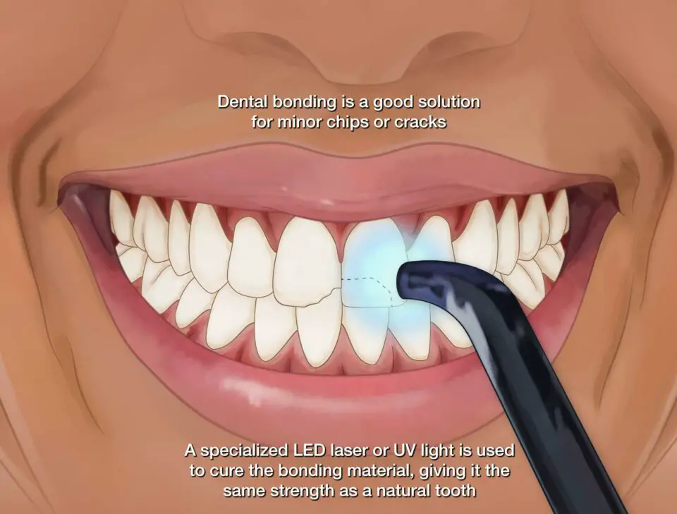 How Much Does Dental Bonding Cost? (Average)