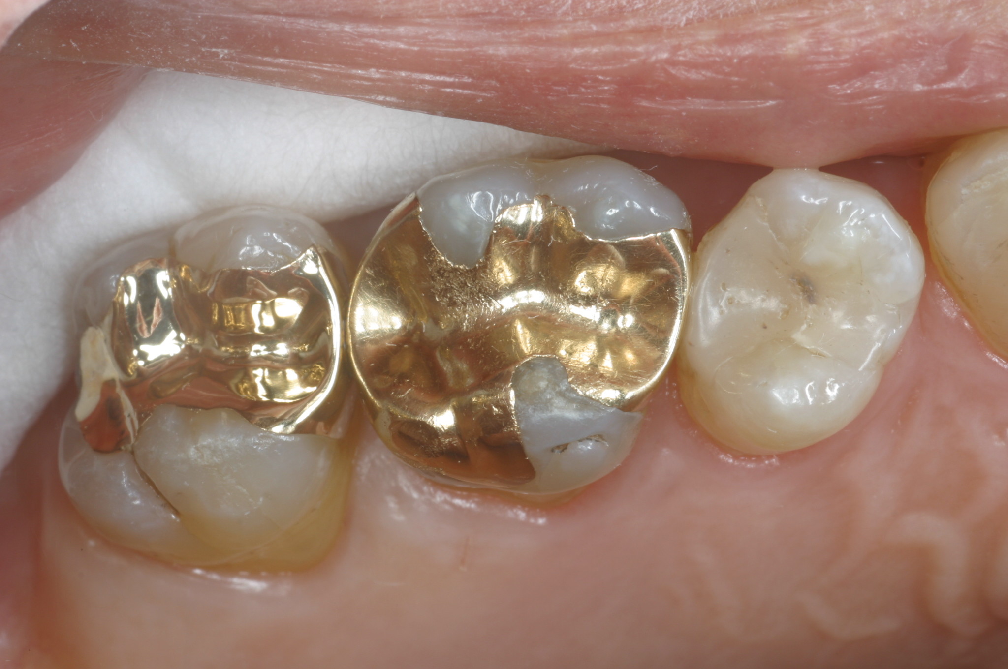 How long do dental gold crowns last