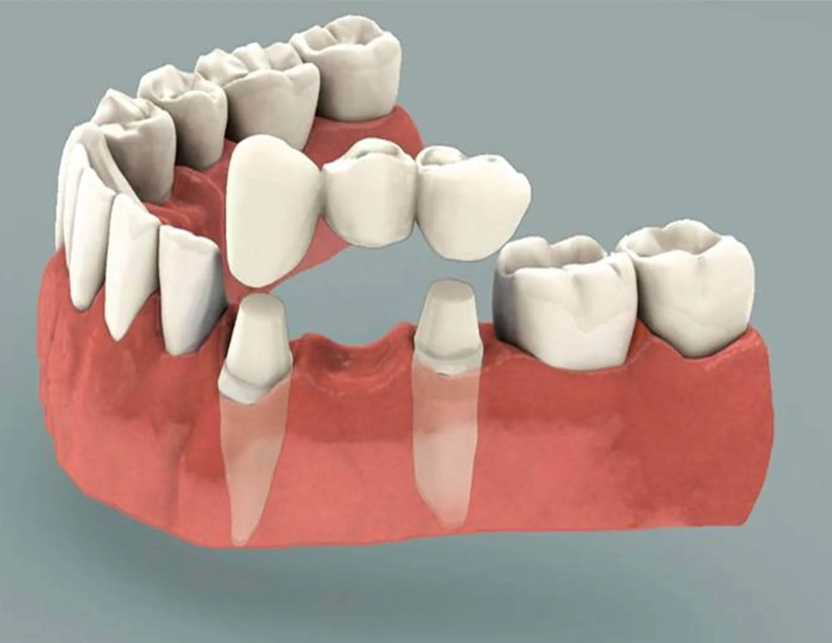 Is it Worth it to Get a Dental Bridge?