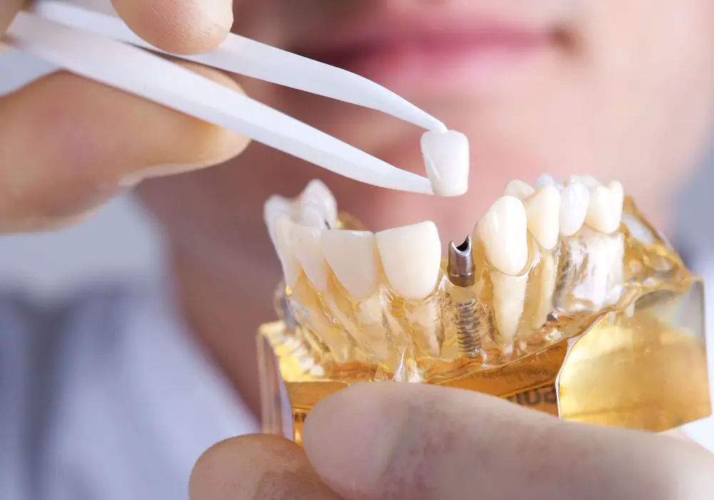 Is it Worth it to Get a Full Mouth of Dental Implants?