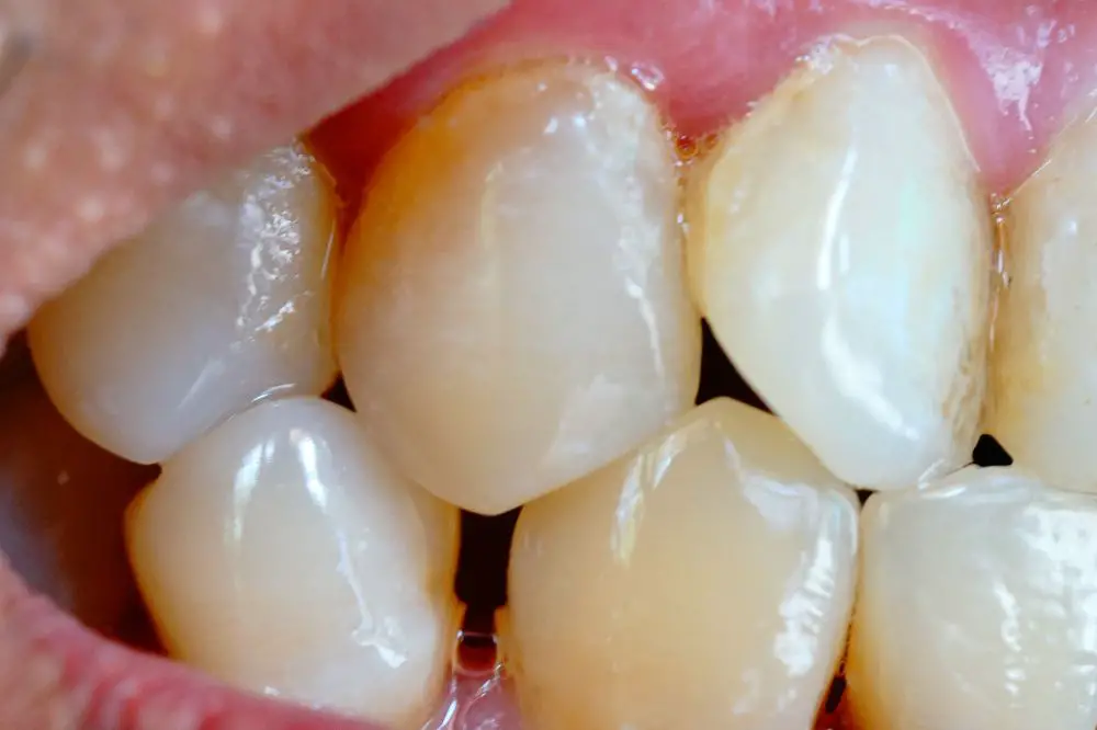 Plaque build-up on your teeth