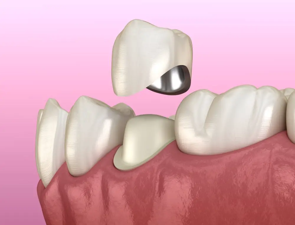 Porcelain Fused to Metal Crowns