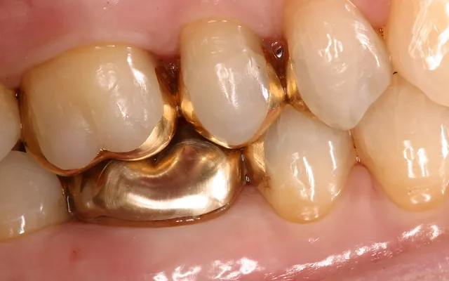 What does dental gold look like