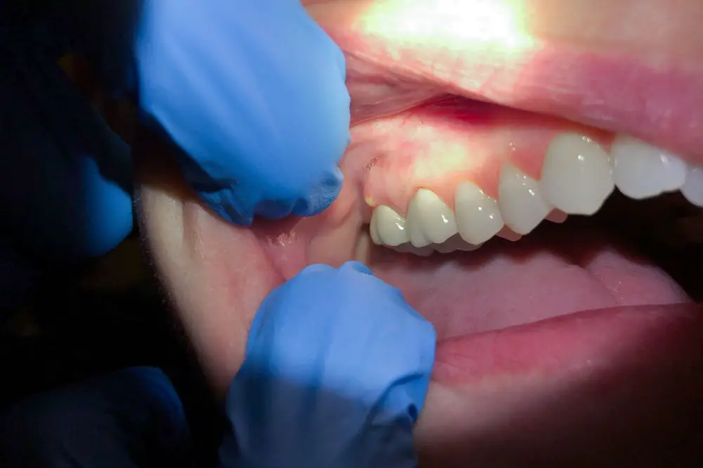 What to Do if a Dental Abscess Bursts on Its Own?