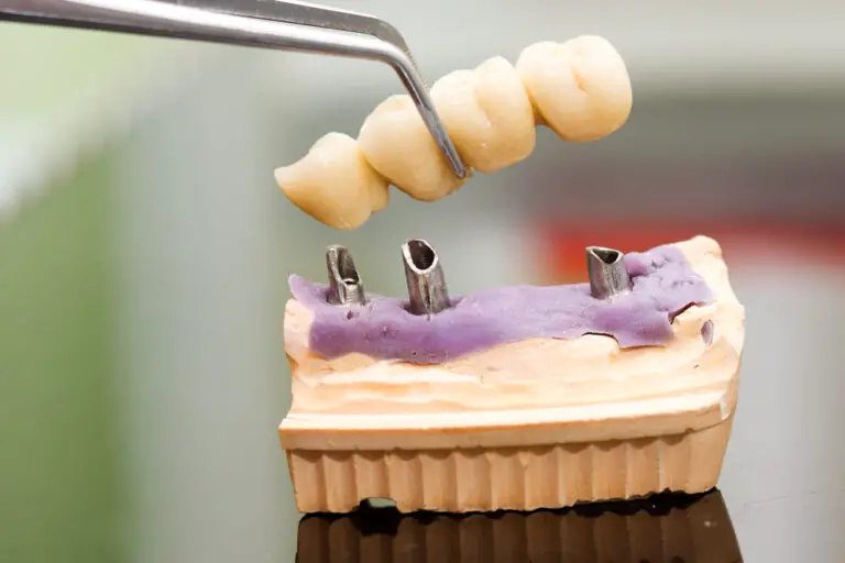 How Much Does A Dental Bridge Cost? (Types & Materials)