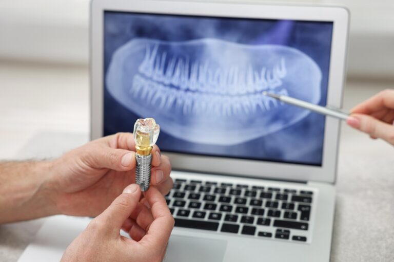 How Much Does It Cost To Get A Full Mouth Of Dental Implants? (Average)