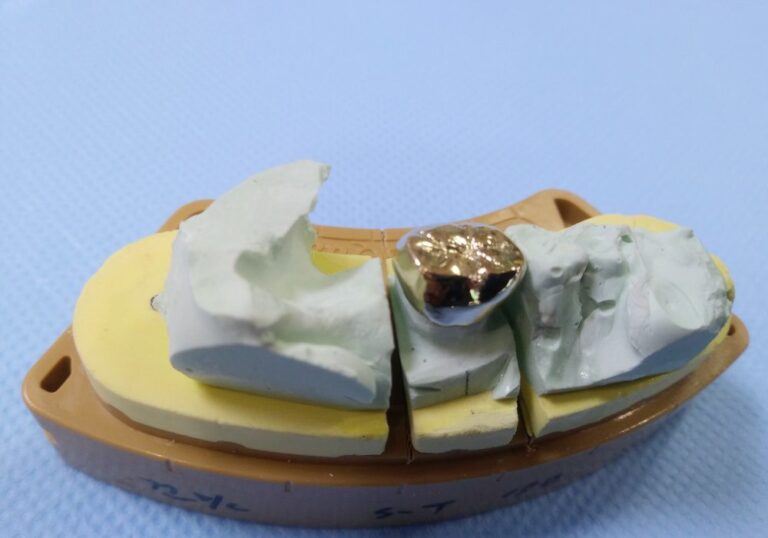 How Much Is Dental Gold Worth? (Evaluation Guide)