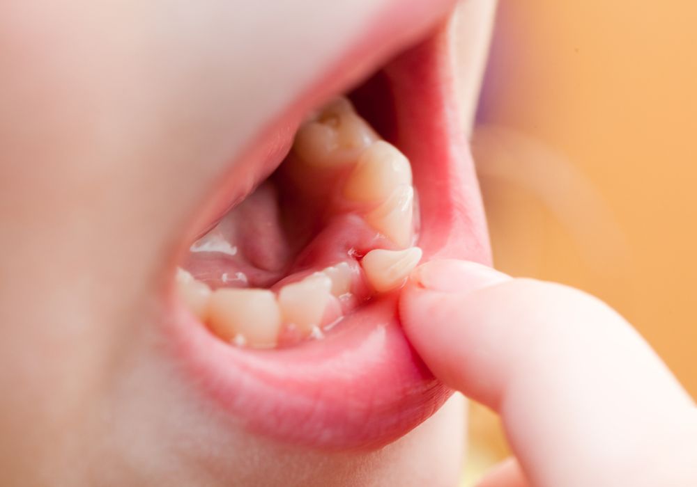 Can Adult Teeth Grow Before Baby Teeth Fall Out?