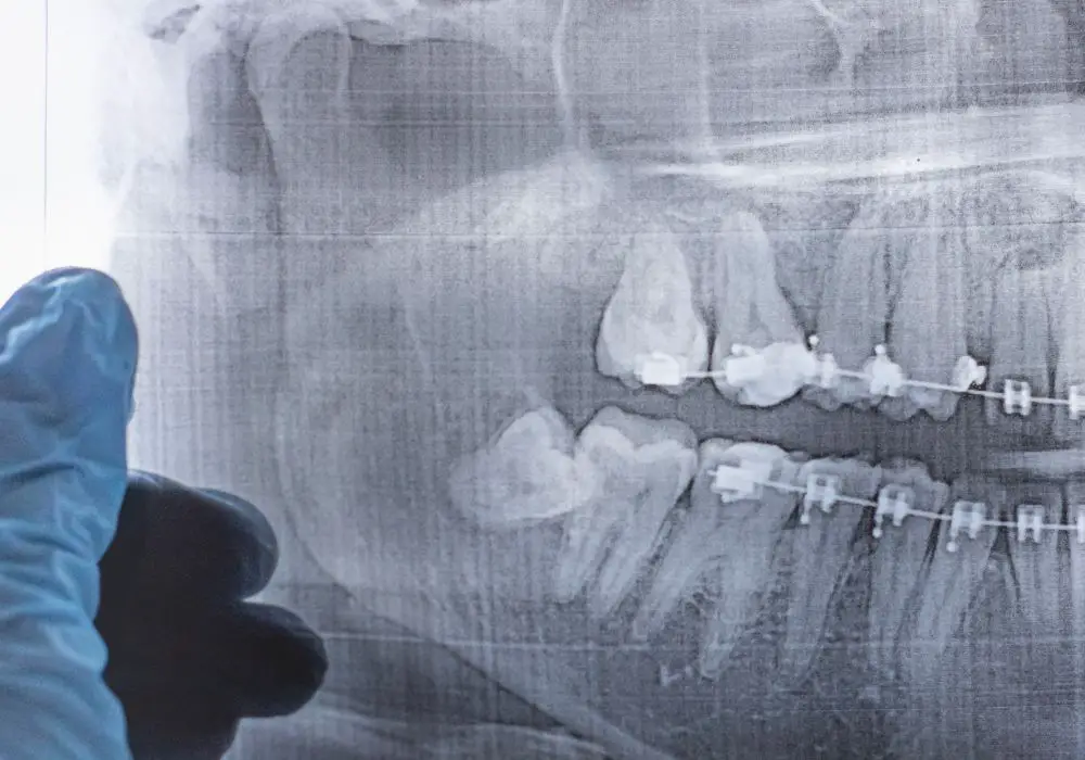 Can I Smoke After Wisdom Teeth Removal?