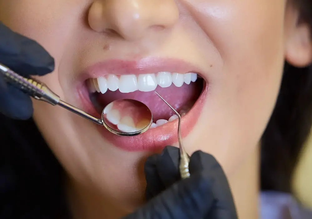 Factors That Affect the Life of Dental Fillings