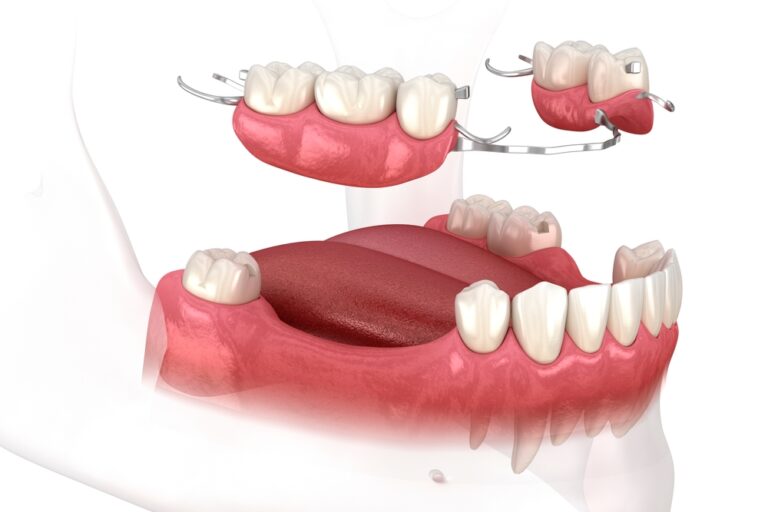 How Much Does A Dental Flipper Cost? (Ultimate Guide)