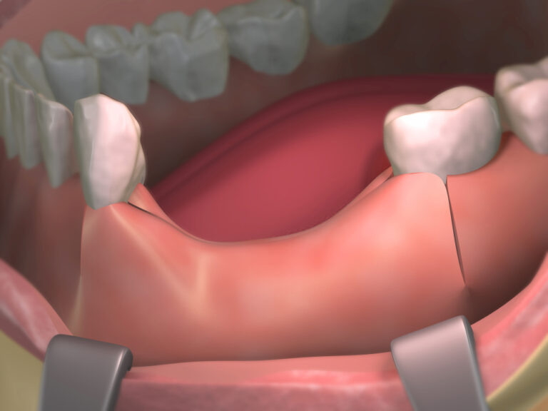 How To Slow Down Bone Loss In Teeth? (Prevention And Treatment)