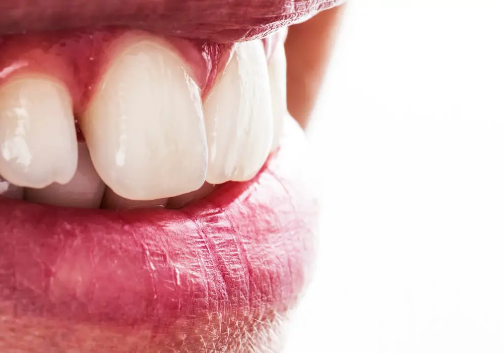 How to Fill the Gap Between Teeth and Gums Naturally