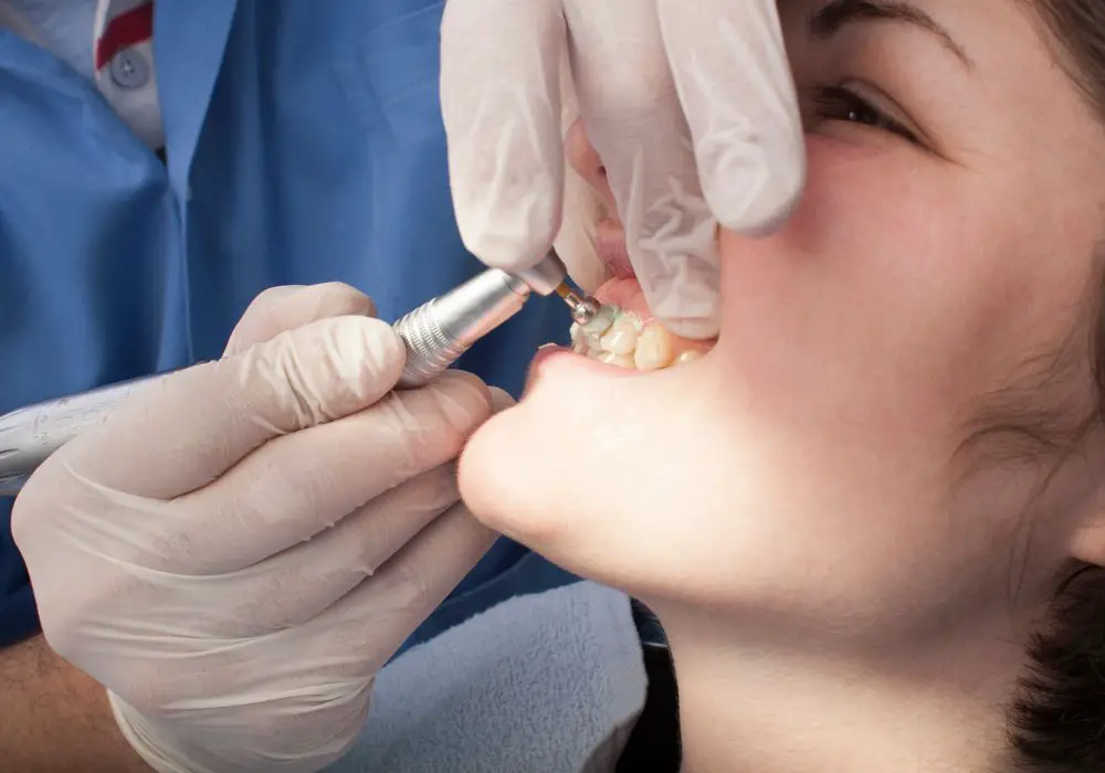 How to Look After Your Teeth Following a Dental Cleaning
