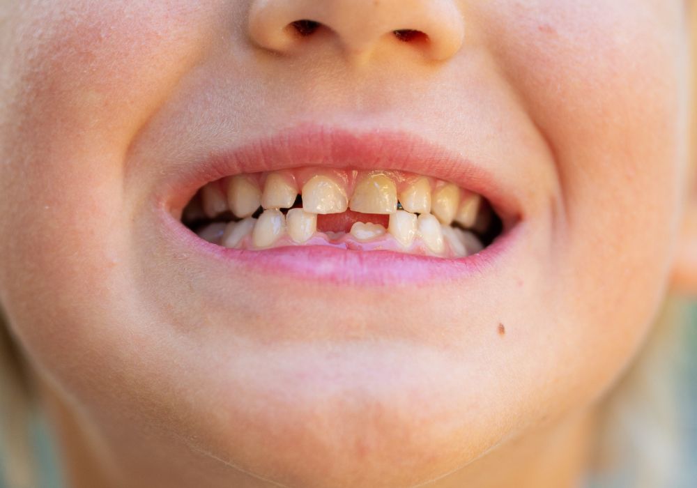 How to Prepare For My Child’s Tooth Loss?