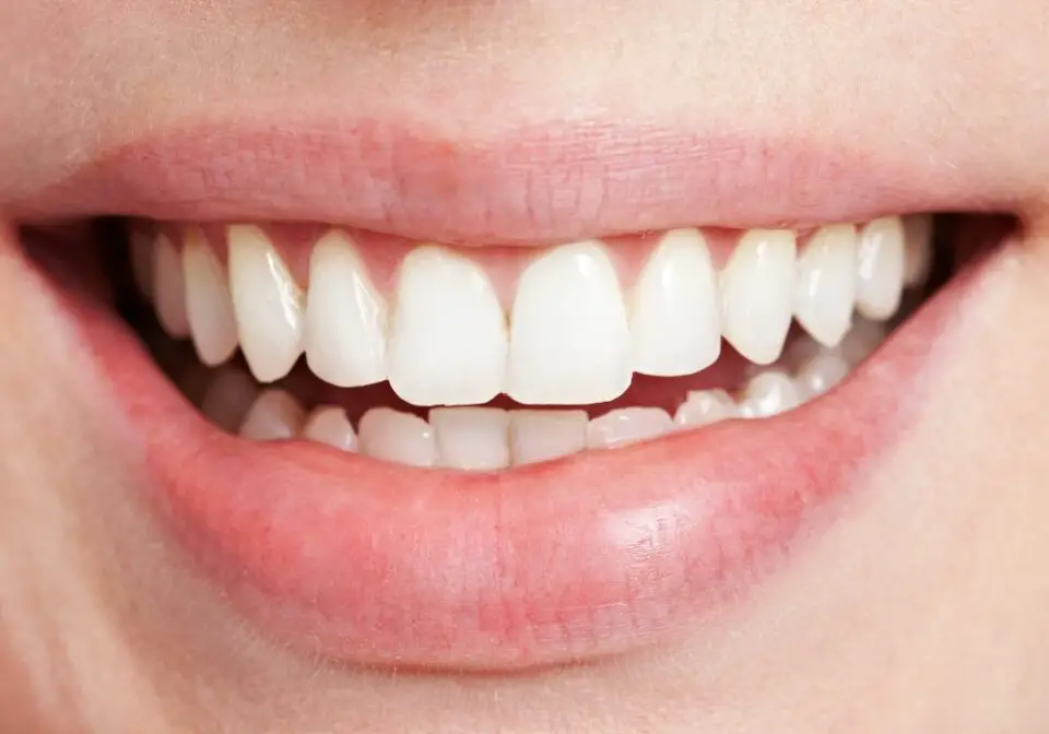 How to Get Rid of White Lines on Teeth Near Gums? (All You Need to Know)