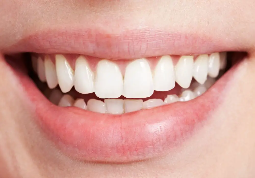 How to Prevent White Lines on Teeth?