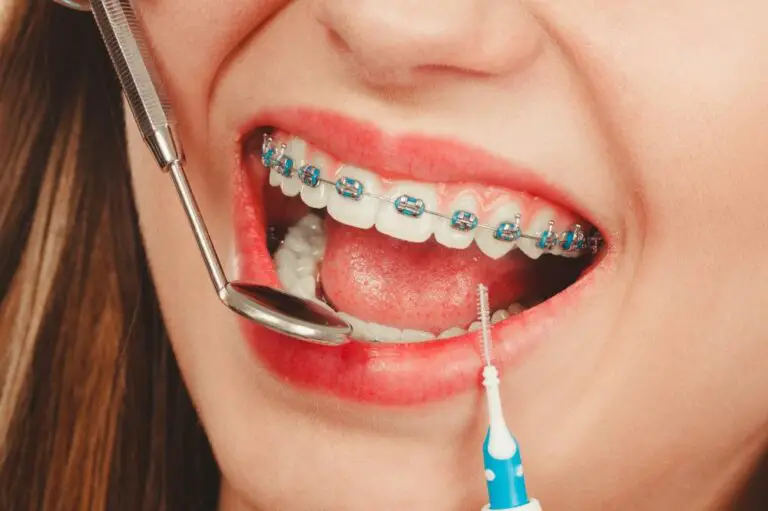How to Whiten Teeth with Braces? (4 Ways)