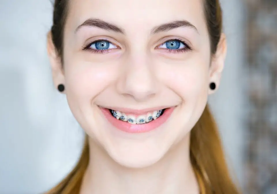 What Color Braces Make Your Teeth Look Whiter? (7 Tips For Choosing)