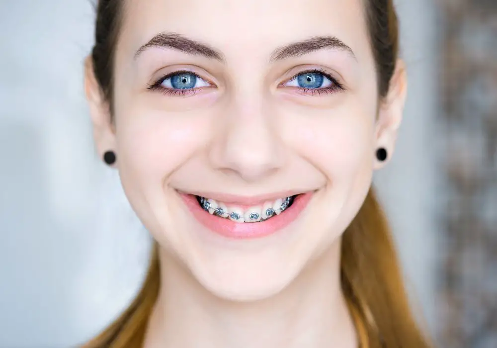 The color of your braces can be “gendered” but doesn’t have to be