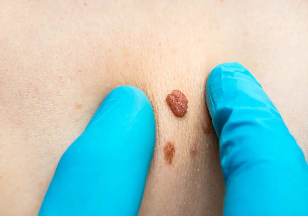 Tied Off Skin Tag Complications