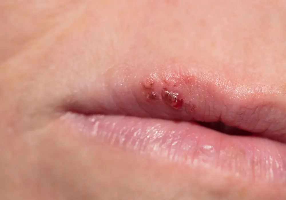 Tips to Prevent Cold Sores After Dental Work