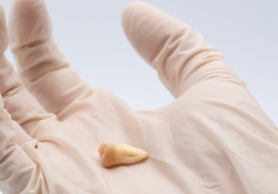 When Can I Eat Spicy Food After Wisdom Teeth Removal? (Ultimate guide)