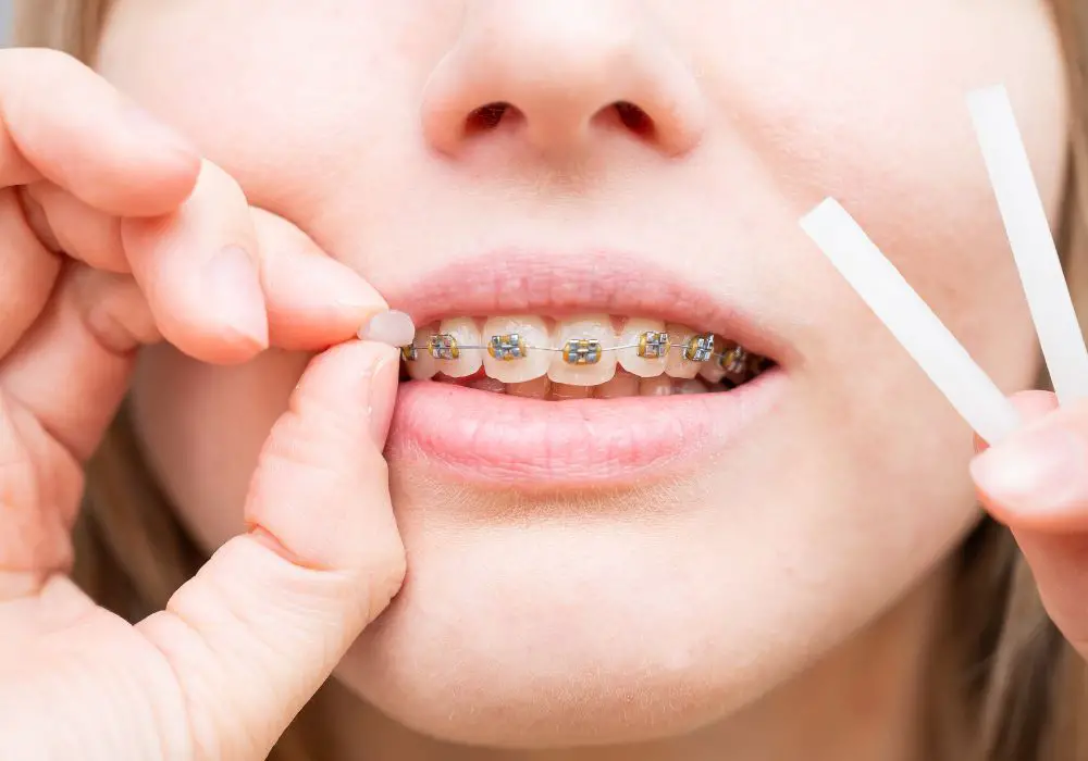 What is Orthodontic Dental Wax