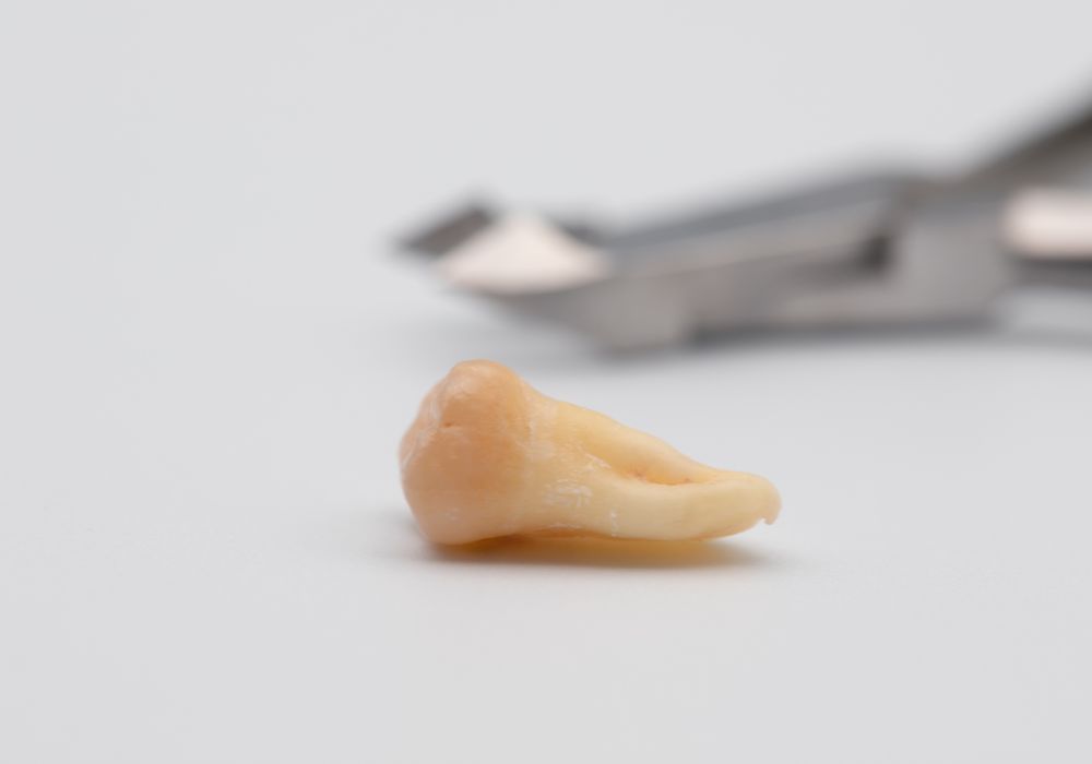 Can I Eat Chicken After Wisdom Teeth Removal?