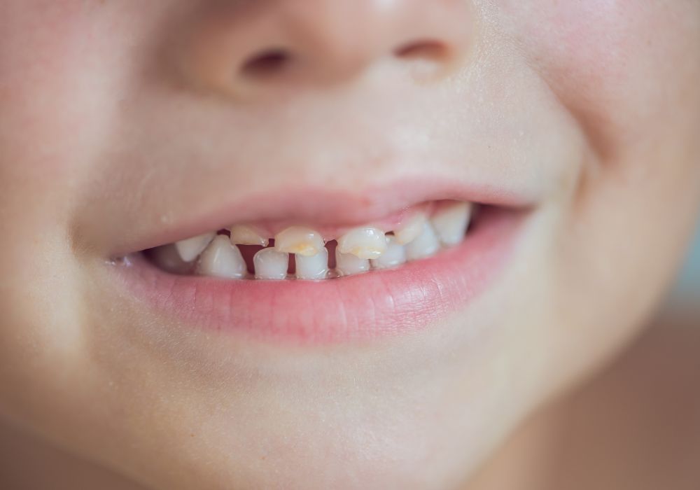 When Do Baby Teeth Fall Out?