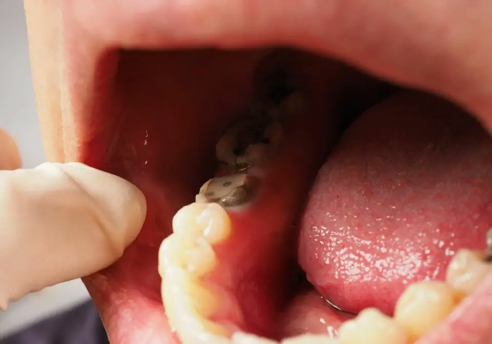 What Does Restorative Dental Treatment Cover? (Ultimate Guide)