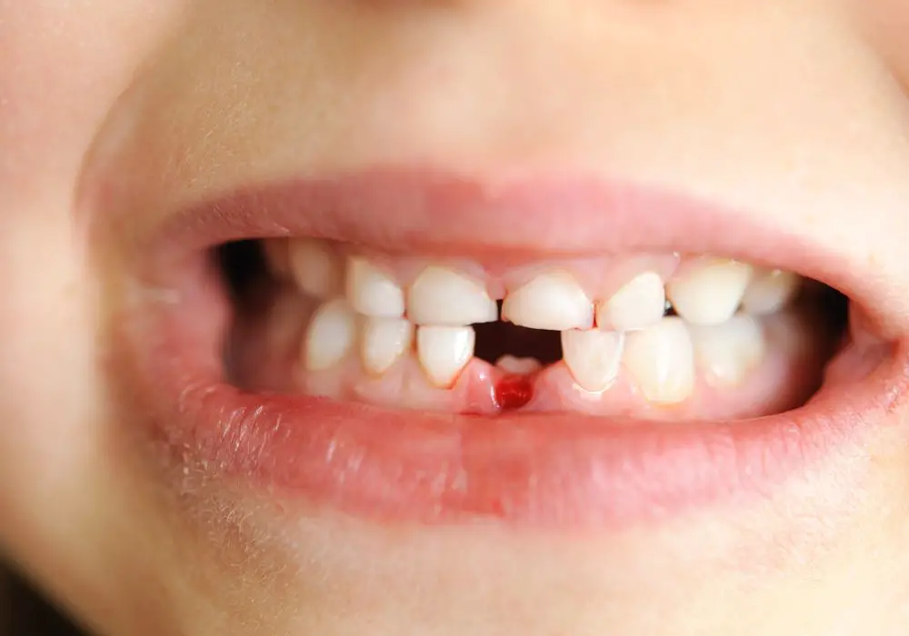Why Aren’t My Kid’s Permanent Teeth Erupting?