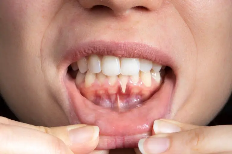 Why Do My Gums Itch Between My Teeth? (Causes & Treatment)