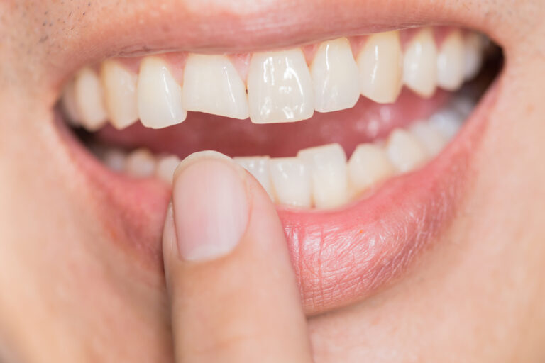 Why Do My Teeth Keep Breaking? (Common Causes & Preventions)