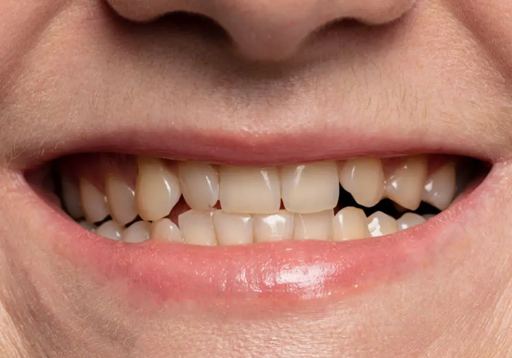 Why Do We Get Yellow Teeth?