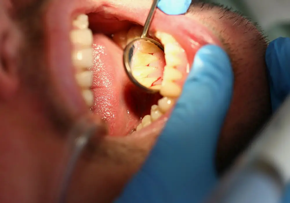 Why Should I Get Rid of Black Spots on Teeth Near Gums?