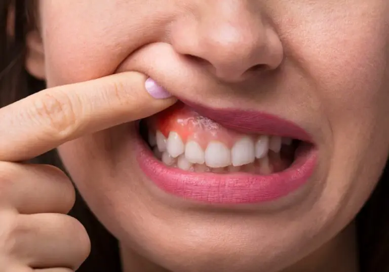 How To Stop Gums from Growing Over Teeth? (Causes & Treatments)