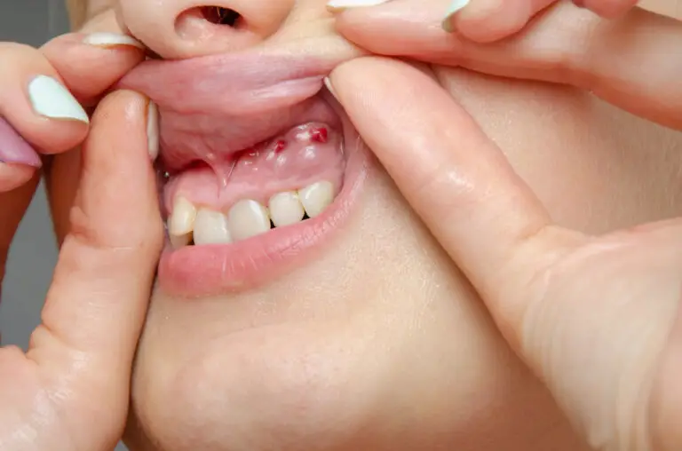 How To Treat A Dental Cyst At Home? (Easy To Follow)