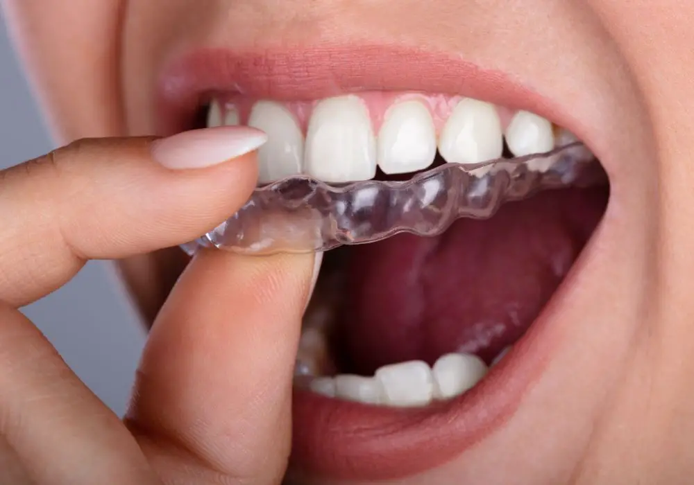 Alternatives for Teeth Realignment
