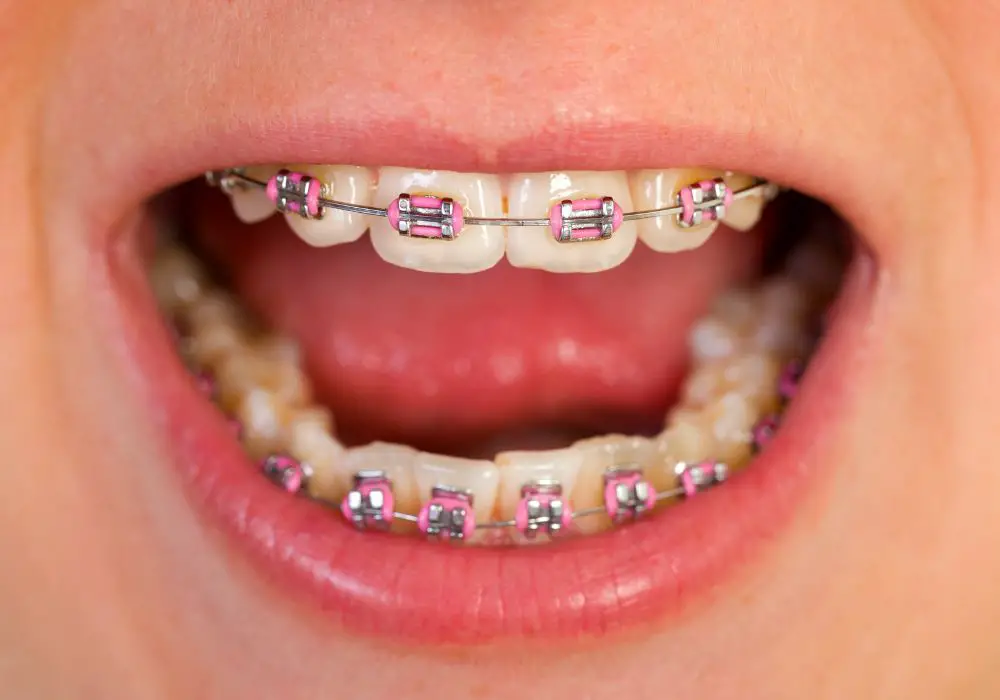 Alternatives if braces could damage your teeth