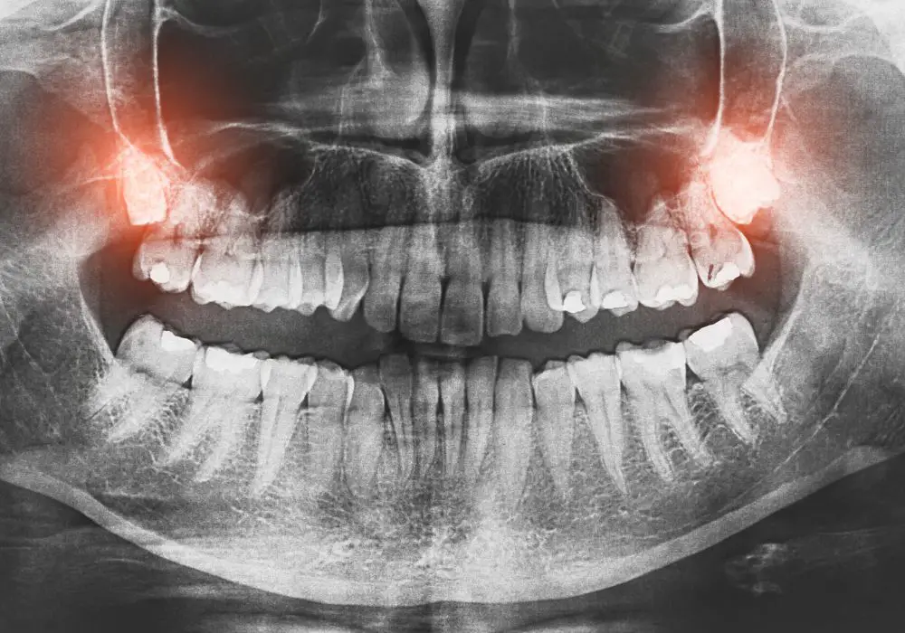 Anatomy of Wisdom Teeth